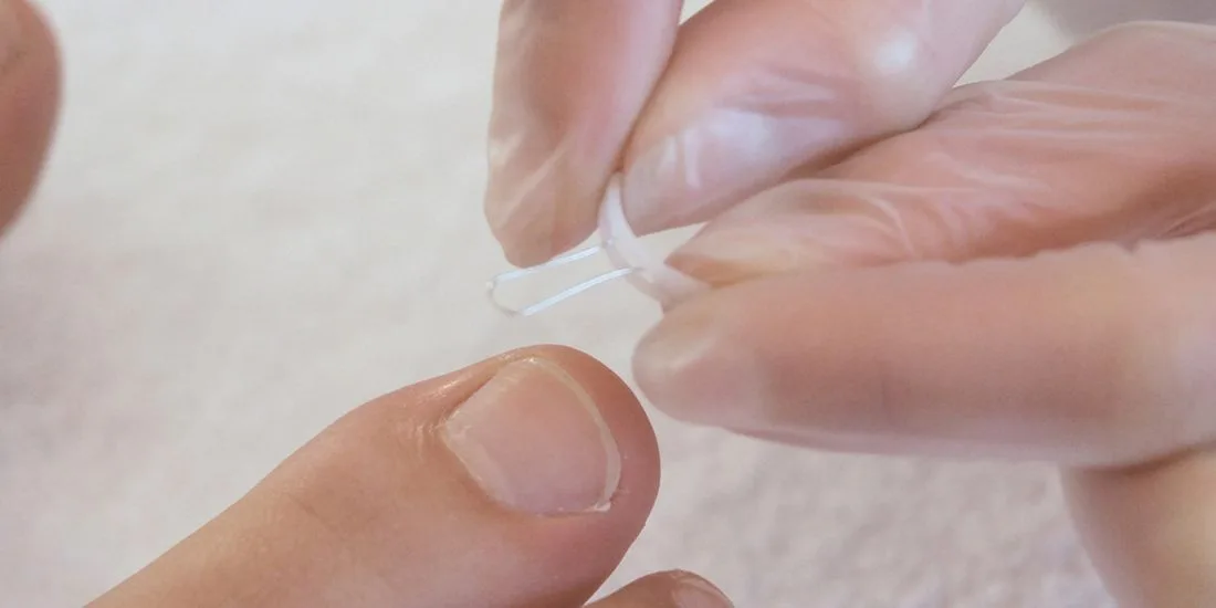 Nail brace pad being shaped to the toenail