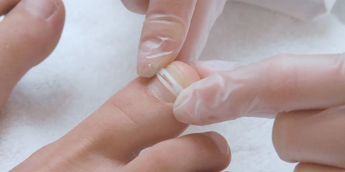 Nail brace being glued to the toenail