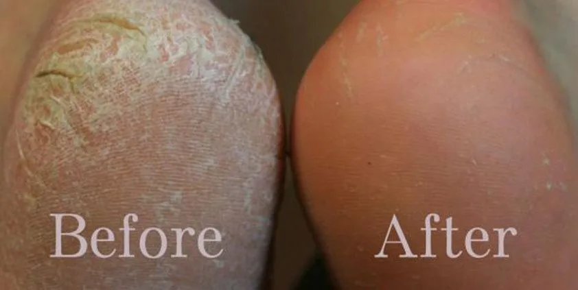 Cracked heel before and after treatment