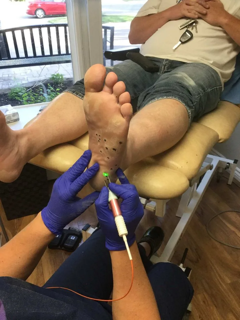 Foot specialist using a laser to treat plantar warts on the sole of a client's foot