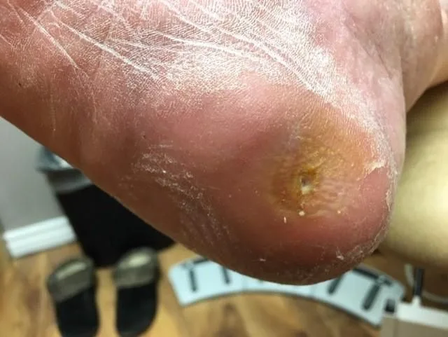 Heel pressure ulcer, after treatment