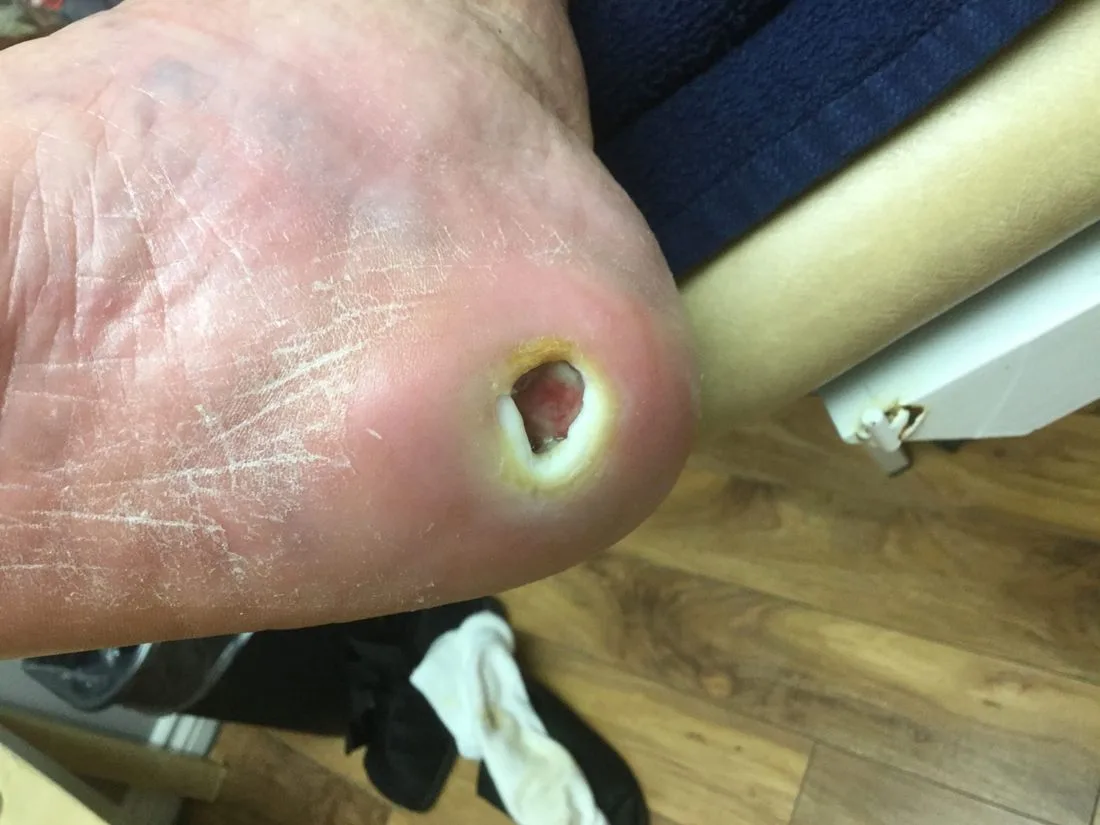 Heel pressure ulcer, before treatment
