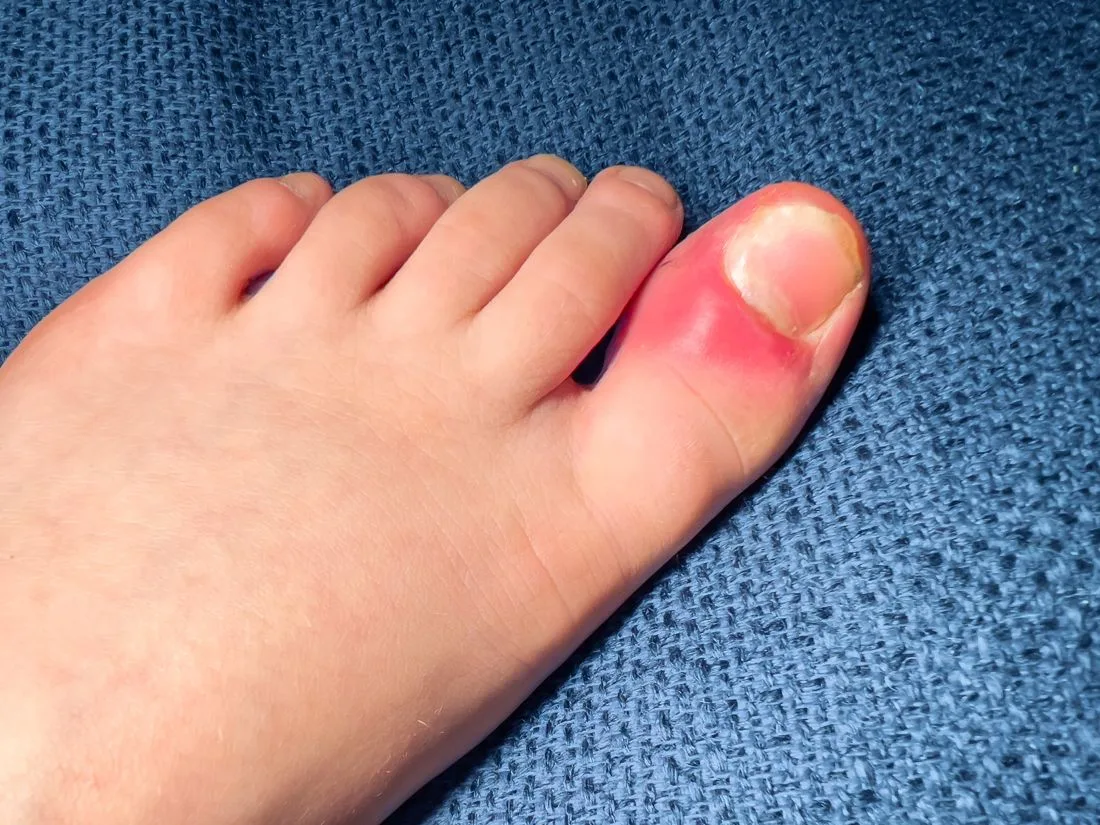 Red, inflamed ingrown toenail on the big toe