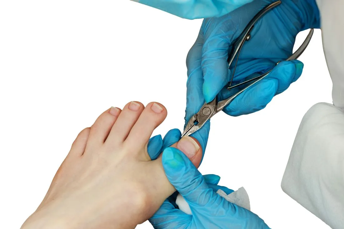 Gloved foot specialist trimming a thick toenail