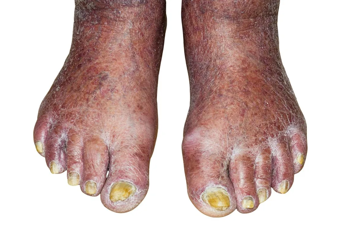 Thick, yellow, infected toenails on both feet