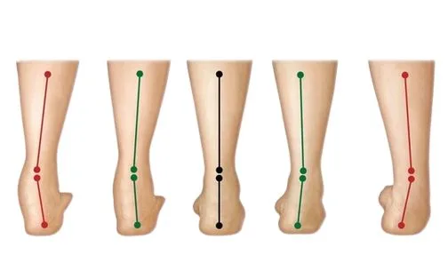 Rear view of feet showing supination, neutral and over-pronation alignment