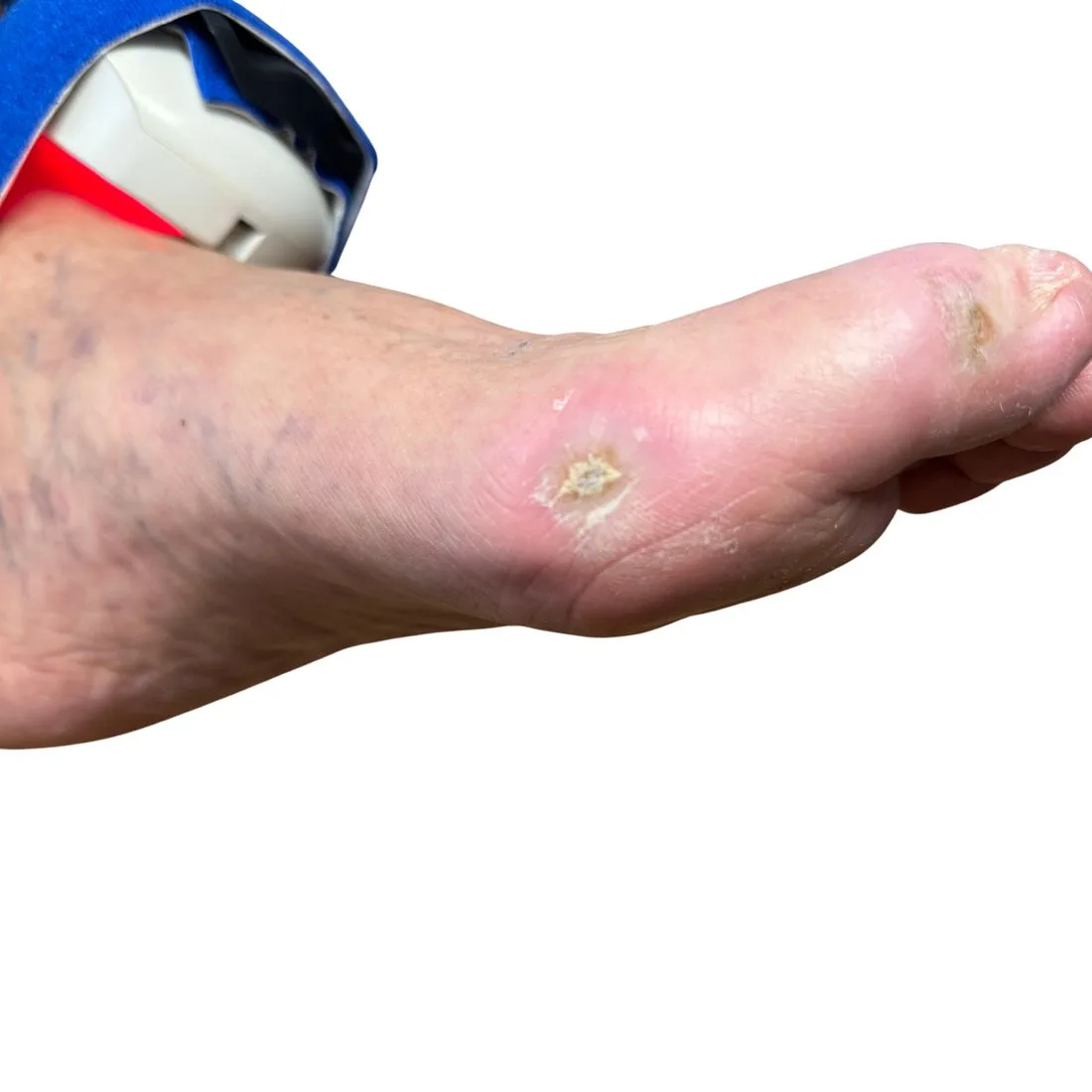 Diabetic toe wound, after treatment