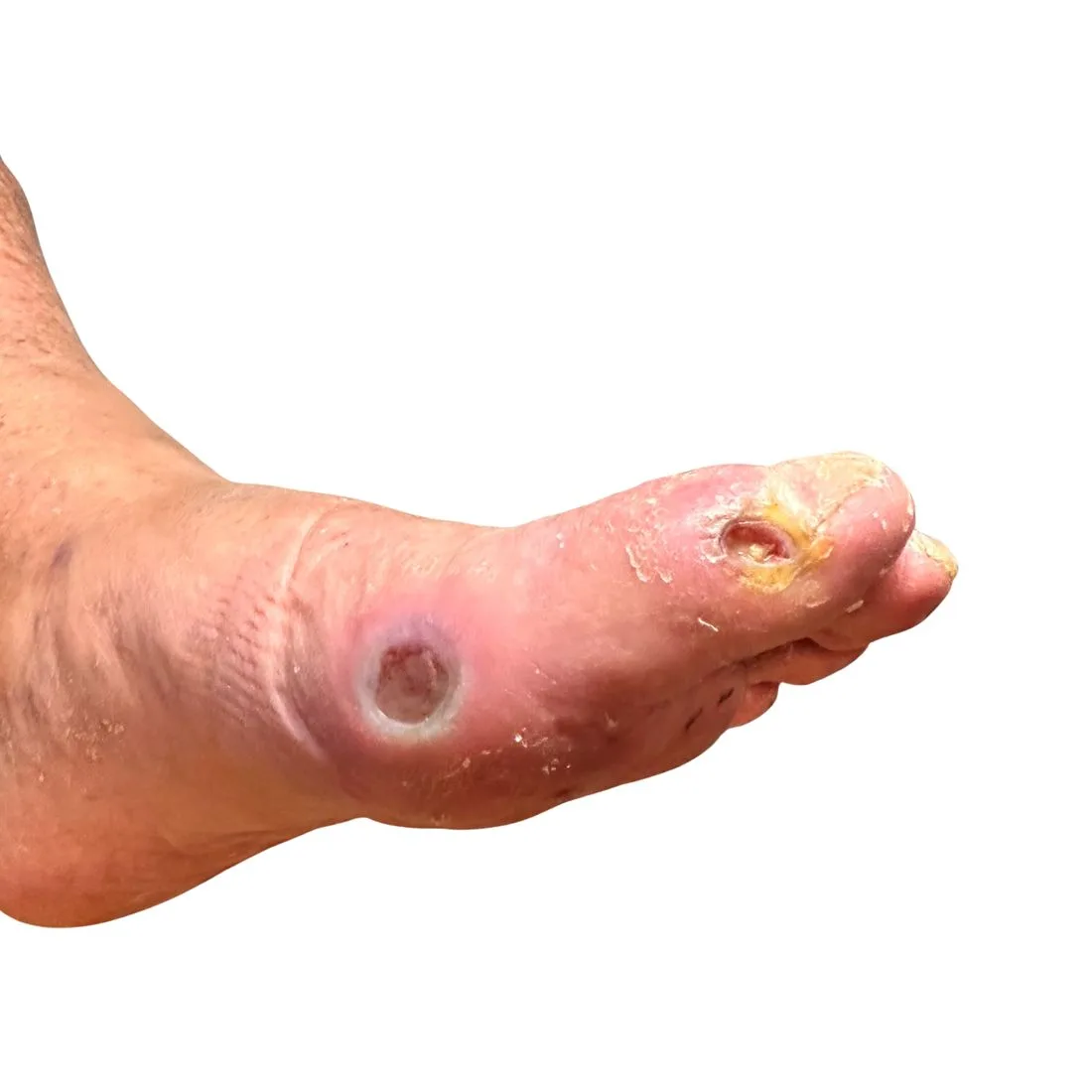 Diabetic toe wound, before treatment